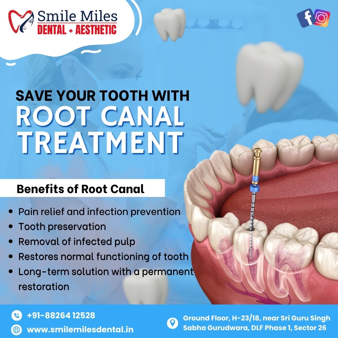 Can a Root Canal Really Be Completed in One Visit?